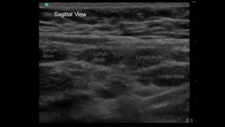 Mesenteric Adenitis in 7 yo Boy with Periumbilical Abdominal Pain and Vomiting [upl. by Spalding]