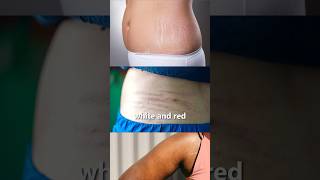 Stretch marks removal cream dermatologist recommended shorts viralshorts [upl. by Ahsenac500]