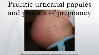 Pruritic urticarial papules and plaques of pregnancy [upl. by Hasile]