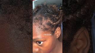 Growing Back My Edges edges type4hair 4chair hairgrowth minoxidil [upl. by Ennaus]