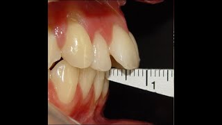 Non Surgical Orthodontic treatment of Skeletal Class II with 7mm Overjet [upl. by Rhoads]