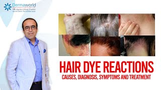 Hair dye reactions  Causes Diagnosis Symptoms and Treatment [upl. by Attah]