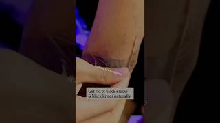 Remove Body Darkness👆Get Rid Black Elbow amp black Knee Naturally 💯Effective viral shorts yt [upl. by Sirtimid218]