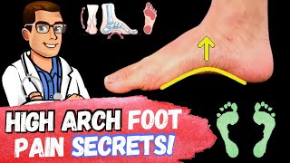 FIX High Arches amp High Arch Feet Supination amp Pes Cavus Foot Type [upl. by Roderich]