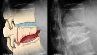 Vertebral Compression Fracture Explained by a Top Pain Physician in Las Vegas Nevada [upl. by Wiltsey]