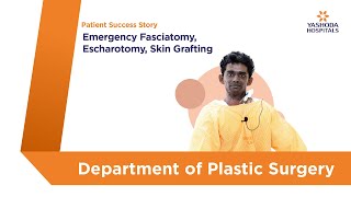 Emergency Fasciotomy Escharotomy Skin Grafting  Yashoda Hospitals Hyderabad [upl. by Festatus]