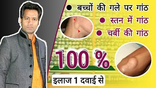 बच्चों के गले पर गांठ  Cervical Lymphnodes  Gale me gilti  Lipoma  Charbi ki ganth Fibroadenoma [upl. by Anner]