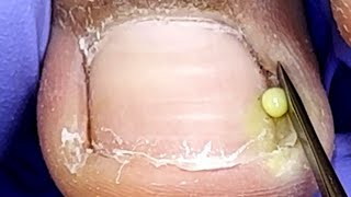 One side of the ingrown nail is sick trim it and apply medicineDoctor Liu Pedicure [upl. by Dominica398]