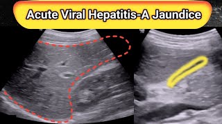 Ultrasound Liver  Acute Viral Hepatitis A  Diagnosis [upl. by Willamina]