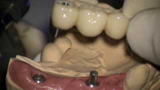 Dental implant Screw and cementretained provisional restoration setting 3 [upl. by Gaskin]