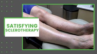 Satisfying Sclerotherapy  Dr Derm [upl. by Rafferty]