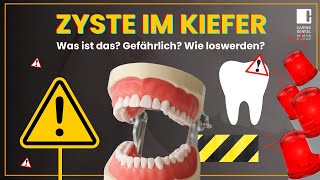 Zyste im Kiefer  Was ist das Entstehung Therapie und Folgen  Carree Dental Köln [upl. by Eneliak]