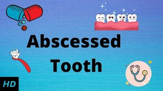 Abscessed tooth Causes SIgns and Symptoms Diagnosis and Treatment [upl. by Enaelem]