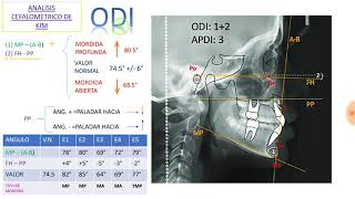 Analisis cefalometrico de kim  ODI [upl. by Delanie]