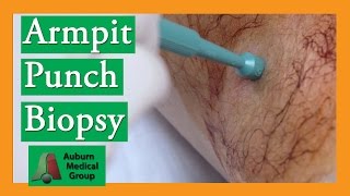 Armpit Sebaceous Cyst Punch Biopsy Removal  Auburn Medical Group [upl. by Dasya]