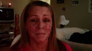 Skin Cancer My Vlogjournal Treatment W EFUDEX vid8 [upl. by Golden]