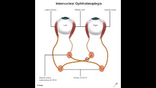 Cause of Opthalmoplegia  Lesion to 3rd 4th 6th cranial nerve [upl. by Woodman]