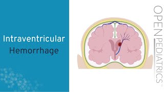 Intraventricular Hemorrhage by A Hansen  OPENPediatrics [upl. by Parsaye]