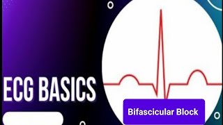 ECG Basics  Bifascicular Block  Electrophysiology and ECG criteria Bifascicular Block [upl. by Sakovich226]