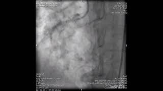 PCI to RCA Instent severly calcified CTO [upl. by Oirromed575]