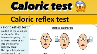 Caloric test explained by practically [upl. by Gerger]