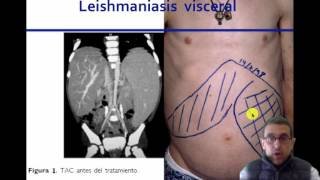 Esplenomegalia Un enfoque fisiopatologico umh 1931 [upl. by Amikan]