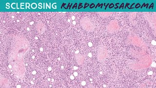 Sclerosing Rhabdomyosarcoma soft tissue pathology sarcoma [upl. by Ilka]