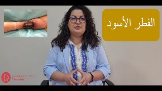 Mucormycosis or Black Fungus  الفطر الأسود الأعراض الأسباب والعلاج الوقاية [upl. by Ruthanne]