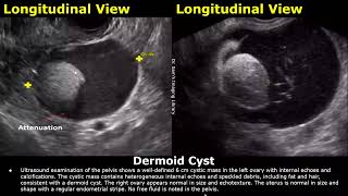 Ovary Ultrasound Reporting  Ovarian Diseases Scan Reports  How To Write USG Report  Pelvic USG [upl. by Vada540]