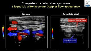 Complete Subclavian Artery Steal Syndrome ultrasound criteria [upl. by Assirrak849]