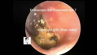 Reexamination and fungal treatment of cholesteatoma [upl. by Sievert482]