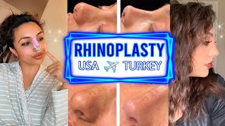 BULBOUS THICK SKIN RHINOPLASTY VLOG TURKEY  DR RESIT BURAK KAYAN  NOSE JOB TURKEY  Hadia [upl. by Leighton450]