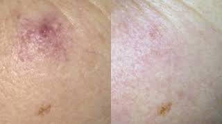 Cherry Angioma removal quick and easy with NDyag laser technology [upl. by Elamaj]