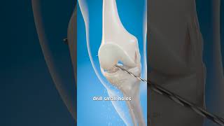 How They Rebuild Torn ACLs 😱 shortvideo ytshorts hindifacts fact [upl. by Euginomod705]