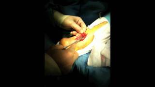 Achilles Tendon Rupture Repair Surgery  Houston Foot Surgeon [upl. by Fin288]