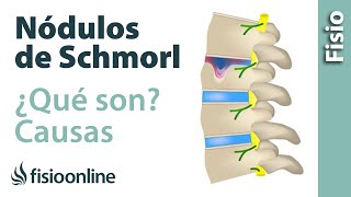 Nódulos de Schmorl  ¿Qué son y cómo sucede [upl. by Yk]