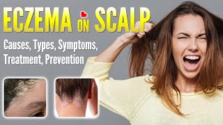 Eczema on Scalp Causes Types Symptoms Treatment and Prevention  Scalp Dermatitis dandruff [upl. by Enalb]