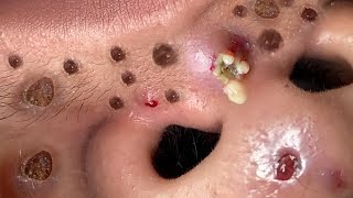 Blackhead Removal With Sac Dep Spa 100074089 [upl. by Anawait]