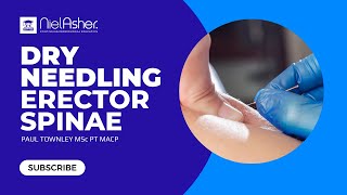 Dry Needling for Trigger Points  Erector Spinae [upl. by Pyle]