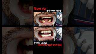 Dental Bridge dentistdentaltreatmentbridge toothmusicdentalclinicsmileshortsyoutubeshorts [upl. by Jamnes861]