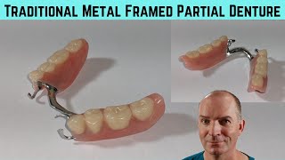 Close up look at a traditional metal framed partial denture [upl. by Ojela]