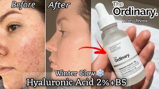 The Ordinary Hyaluronic Acid 2 B5 Serum Honest Review Winter skincare Best Serum For Winters [upl. by Ekenna]