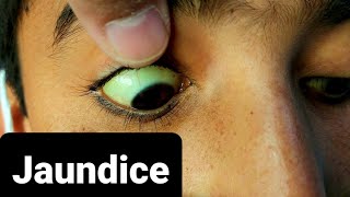 How Jaundice Looks Like [upl. by Ahcatan]