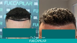 DHI Hair Transplant 2001 Grafts NW II by Dr Turan  FUECAPILAR Istanbul Turkey [upl. by Nosa430]