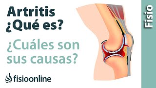 ¿Qué es una artritis y cuáles son sus causas [upl. by Kolnos]