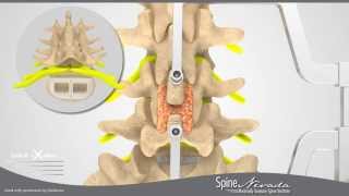 Minimally Invasive Spine Surgery ILIF Interlaminar Lumbar Fusion in Sparks Reno Carson [upl. by Niliram]