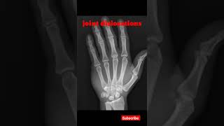 Joint Dislocation  hand xray shorts shortsfeed radiology jointdislocation education [upl. by Gnep817]