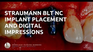 Straumann BLT Implant Placement and Digital Impressions [upl. by Kurys349]