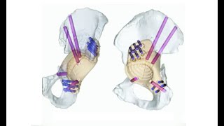 Custom Triflanged Acetabular Reconstruction [upl. by Barraza]