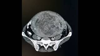 Intramural uterine fibroid [upl. by Hallock]